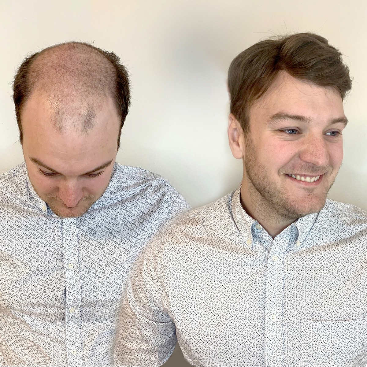 Alopecia Androgenetica bij mannen